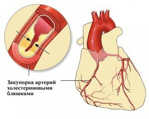 закупорка артерий 