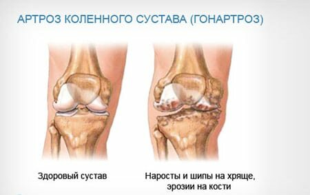 Изменения в больном суставе